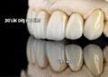 20'lik Diş Nedir?