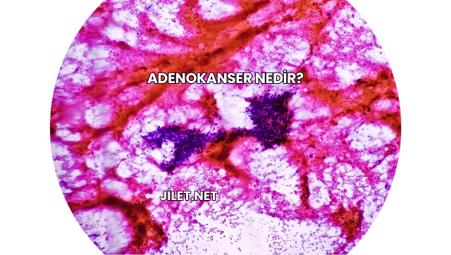 Adenokanser Nedir?