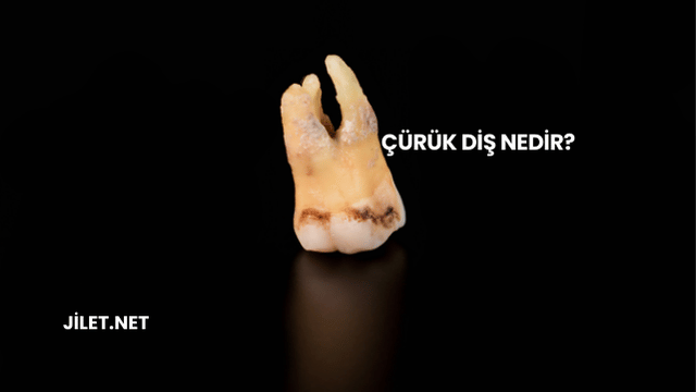 Çürük Diş Nedir?