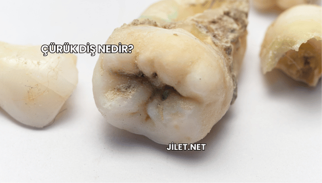 Çürük Diş Nedir?