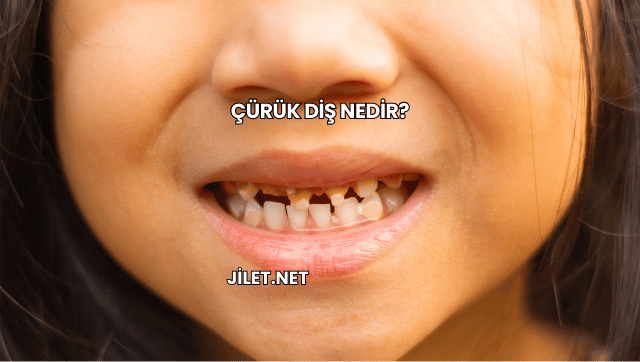 Çürük Diş Nedir?