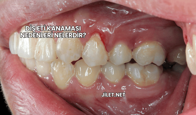Diş Eti Kanaması Nedenleri Nelerdir?